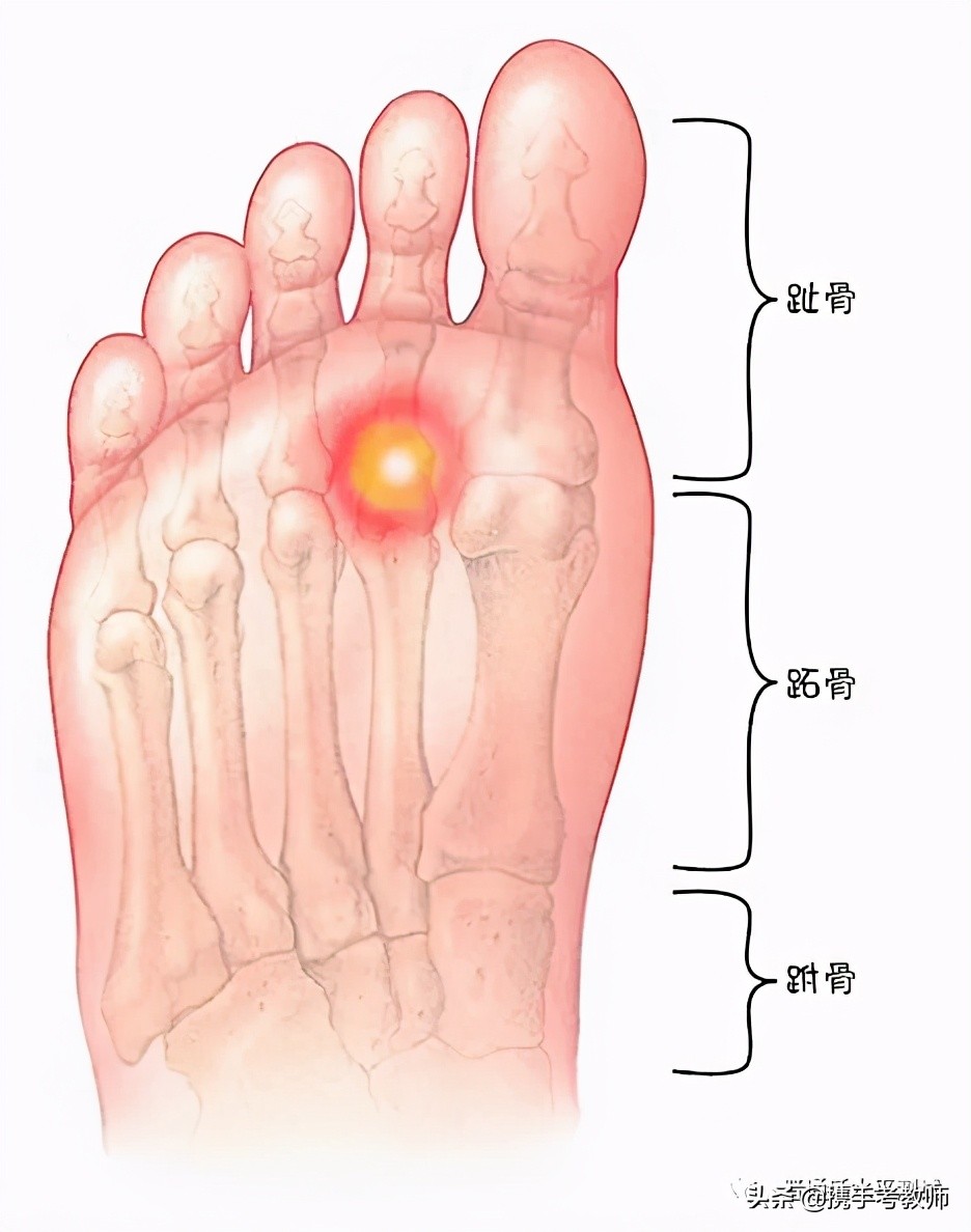 跖骨的"跖"怎么读?
