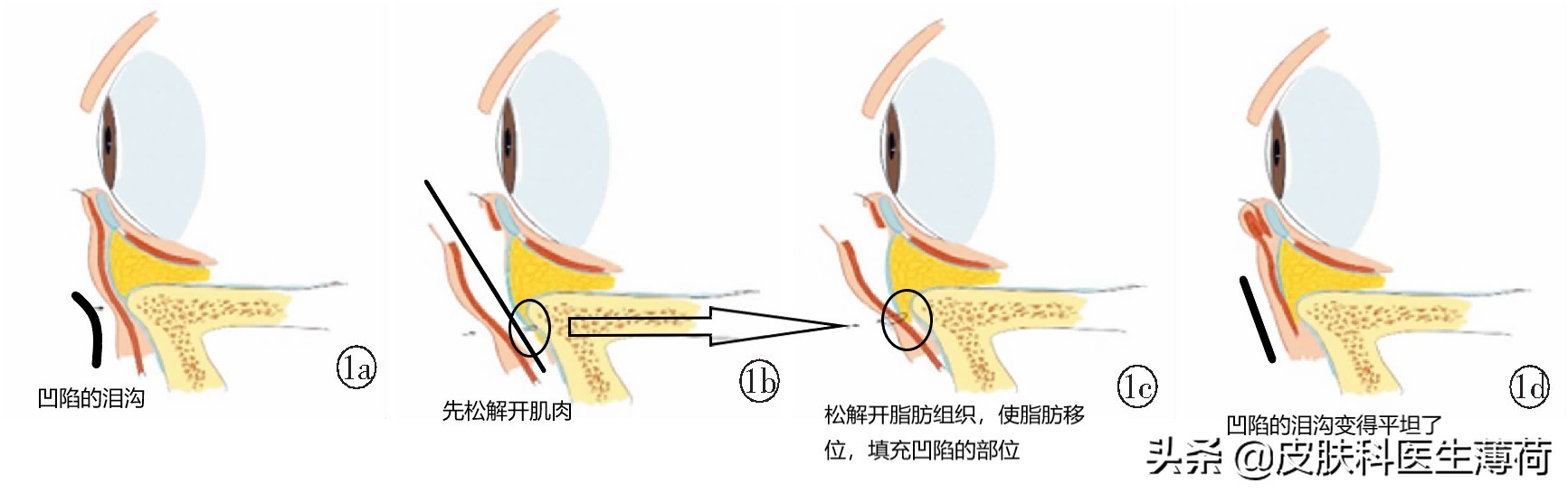 黑眼圈怎么形成的？如何彻底的去黑眼圈？|皮肤科医生良心出品