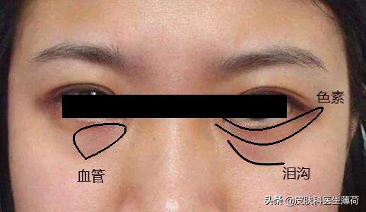黑眼圈怎么形成的？如何彻底的去黑眼圈？|皮肤科医生良心出品