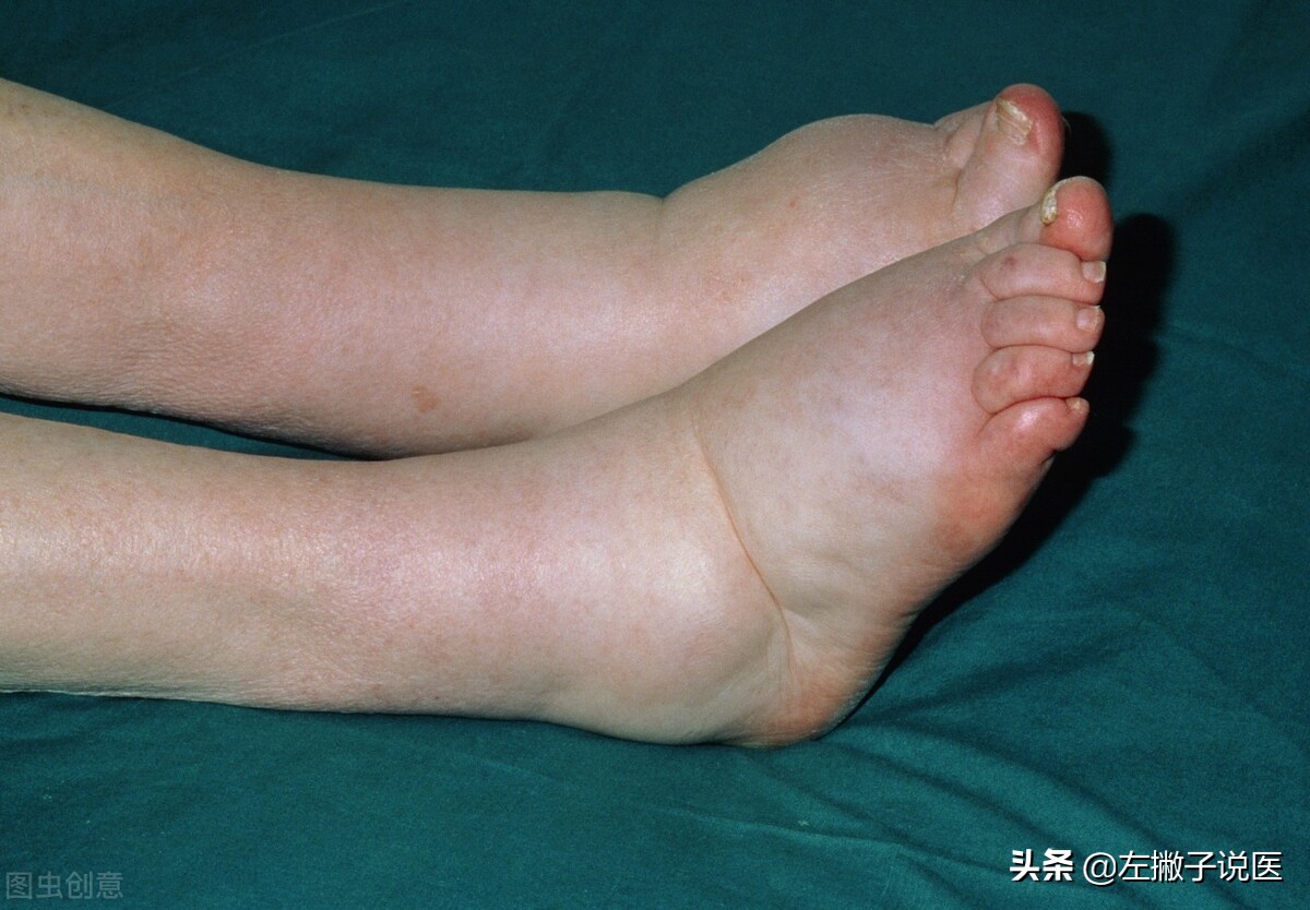 下肢出现水肿,是水喝多了还是肾脏出现问题了?本文告诉您真相