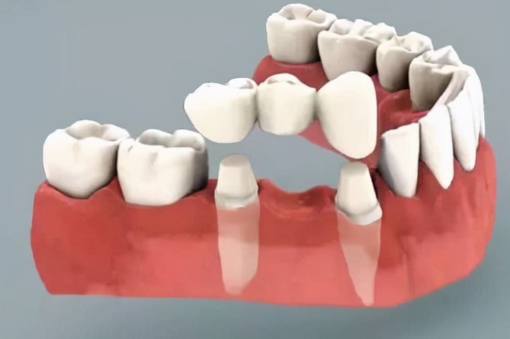科学道理我就不解释了,我只说一句——搭桥的前提是将另外两颗牙齿磨