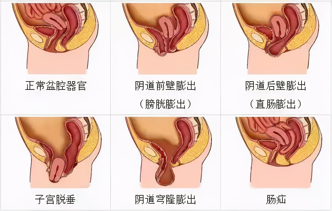 慌了！子宫、肠子、膀胱…都可能“掉出来”？这七类女性需注意