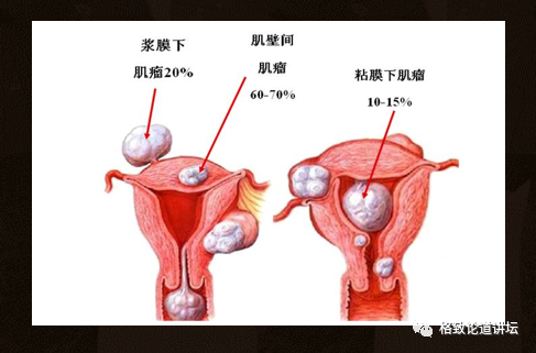 子宫在身体的什么位置图如何保护子宫