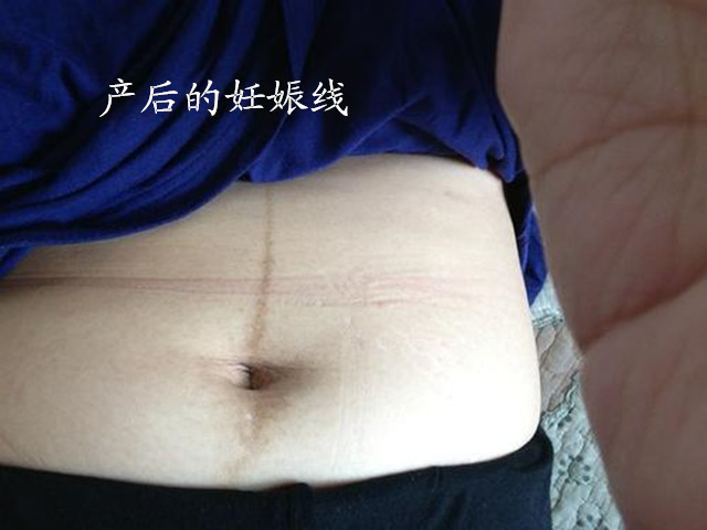 怀孕后肚皮上长“黑线”？准妈妈别苦恼，做好4件事有利于恢复