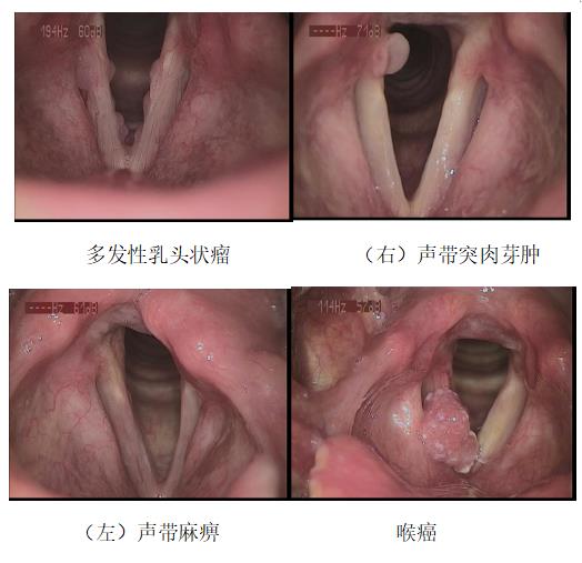 耳鼻喉医话丨我声音嘶哑了，喉镜检查必须做吗？