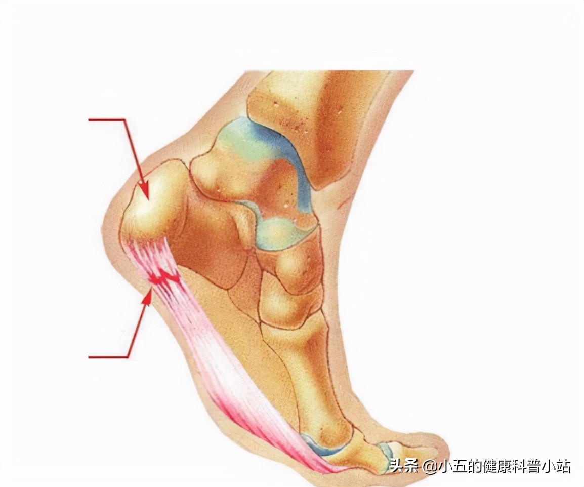 突发足跟痛要考虑这5种疾病，日常保健和治疗要注意6点