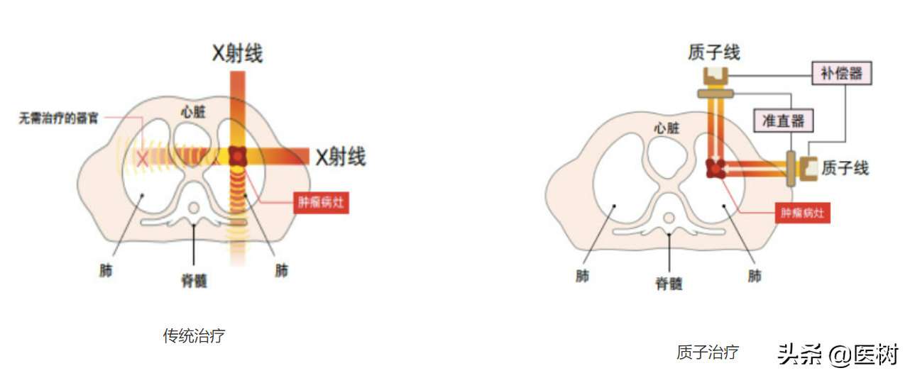 果断、干脆！直接打断癌细胞DNA，射线治疗为何如此豪横？