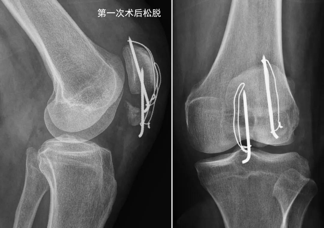 2020三院新技术 | 异形垫片，纵横连接——髌骨下极粉碎骨折的新选择