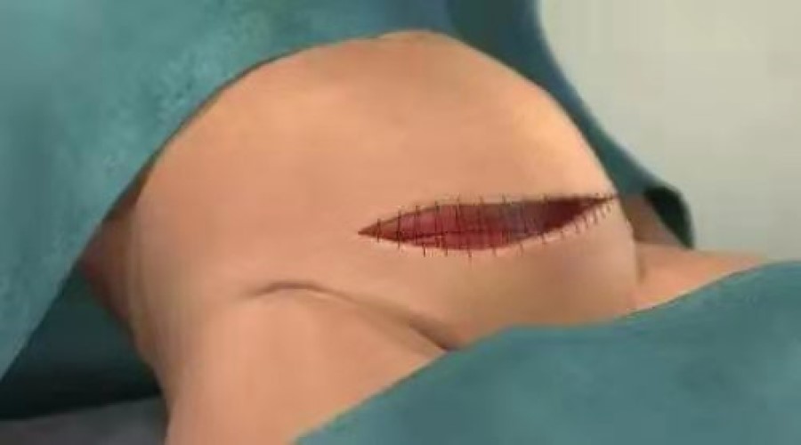 别再鄙视剖腹产生娃的了!这组过程图,谁看谁心疼