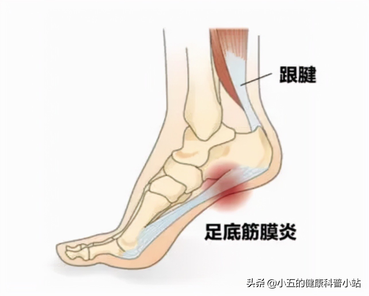 突发足跟痛要考虑这5种疾病，日常保健和治疗要注意6点