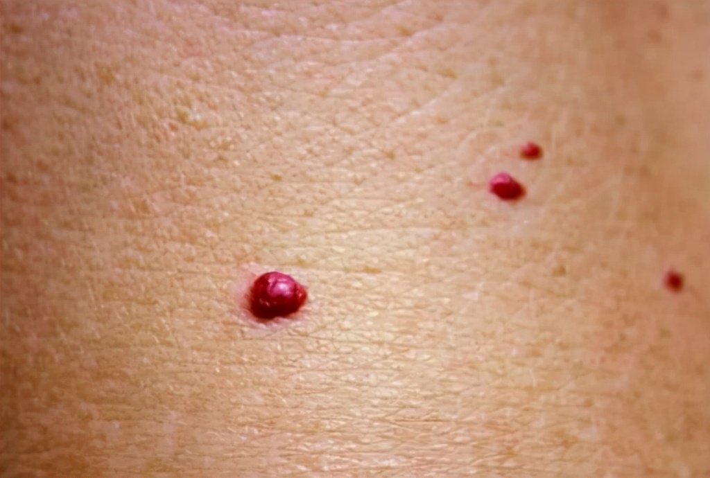 医生告诉王女士,身上起的红点正是因为肝病导致的.