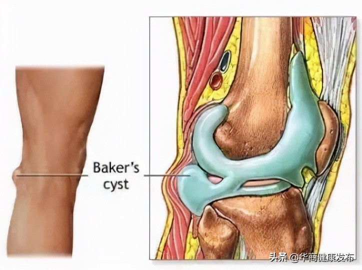 4个0.5cm微小切口的手术巧取膝关节腘窝囊肿