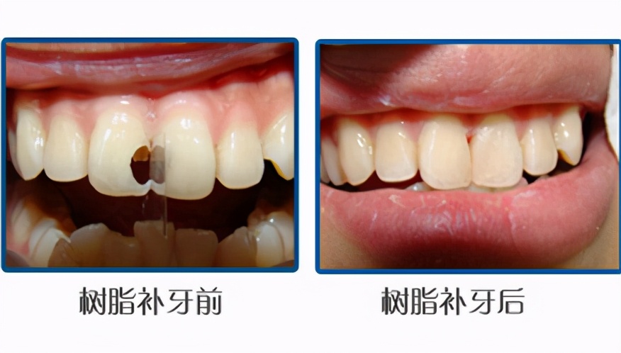 牙齿修复价格牙齿缺损该如何修复