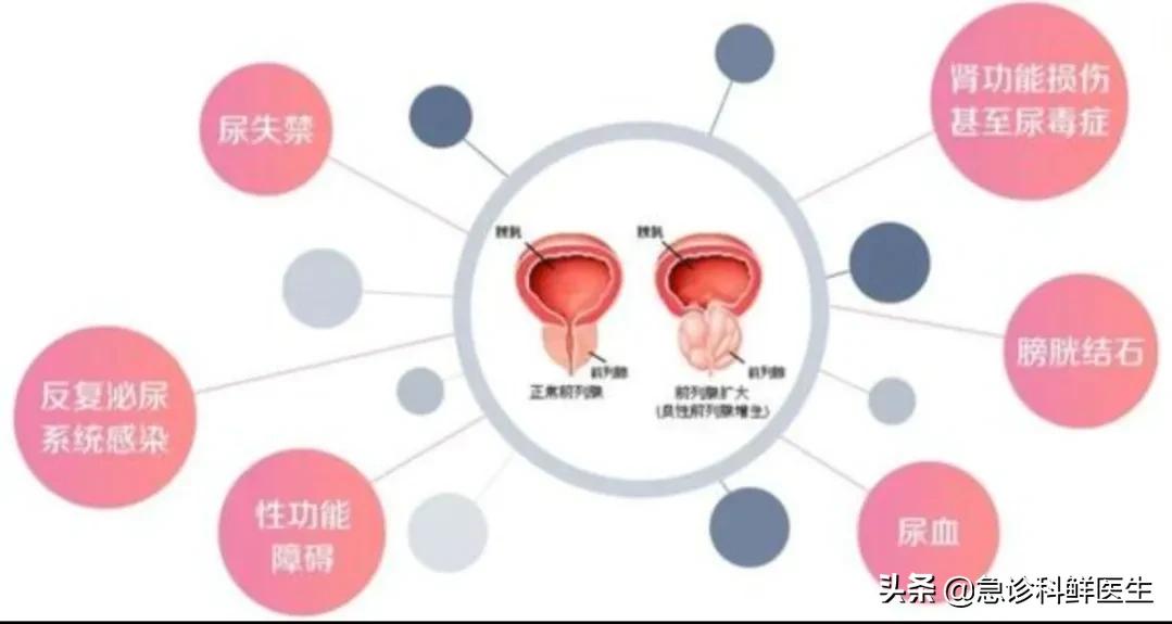 得了前列腺增生怎么办？前列腺增生能否治愈？医生一文为你说清楚