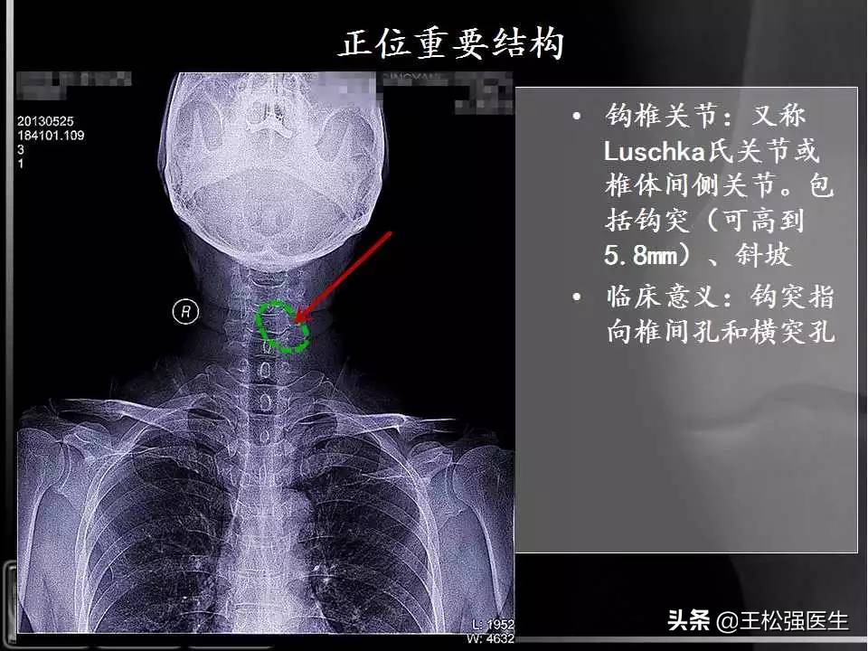 颈椎X光片