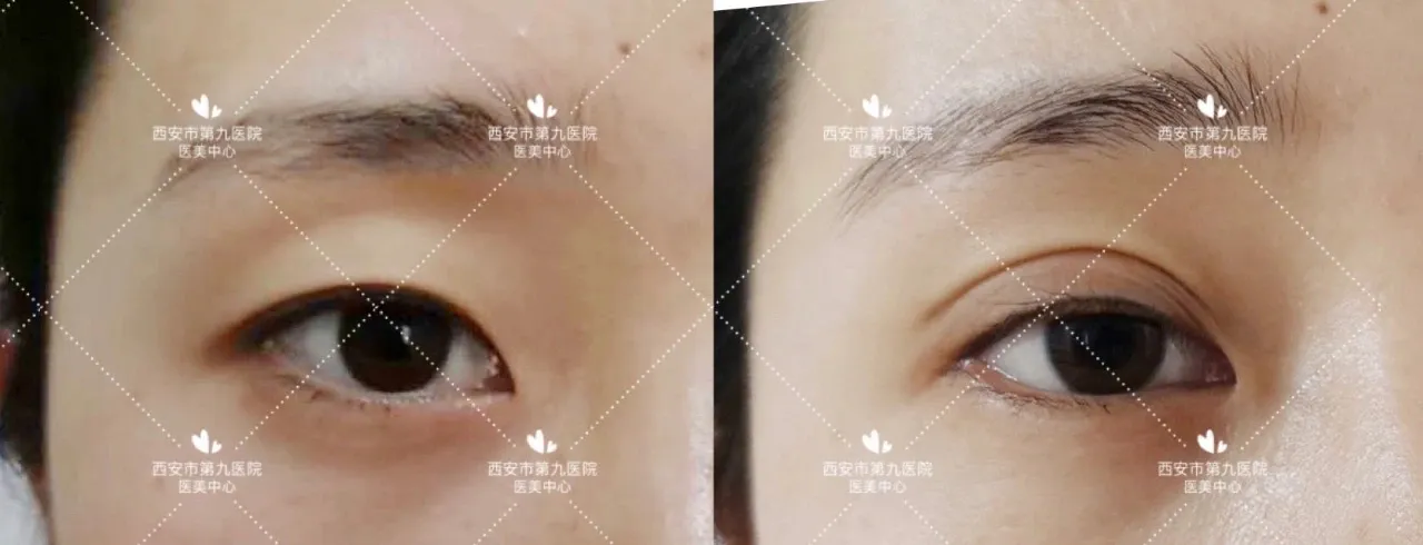 【活动播报】西安市第九医院“暑期特惠”活动启动啦!