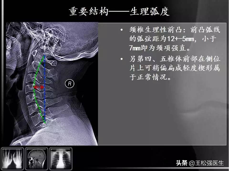 颈椎X光片