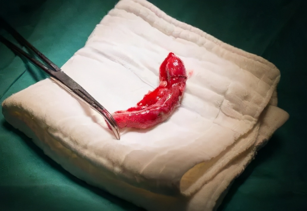 阑尾炎怎么查出来(阑尾知多少?