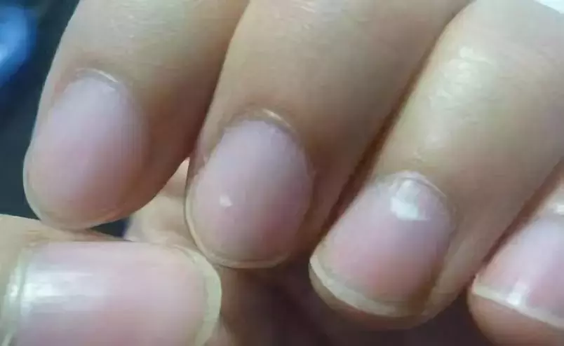 指甲长竖纹、白斑、黑线是疾病征兆？这些实情，现在知道还不晚