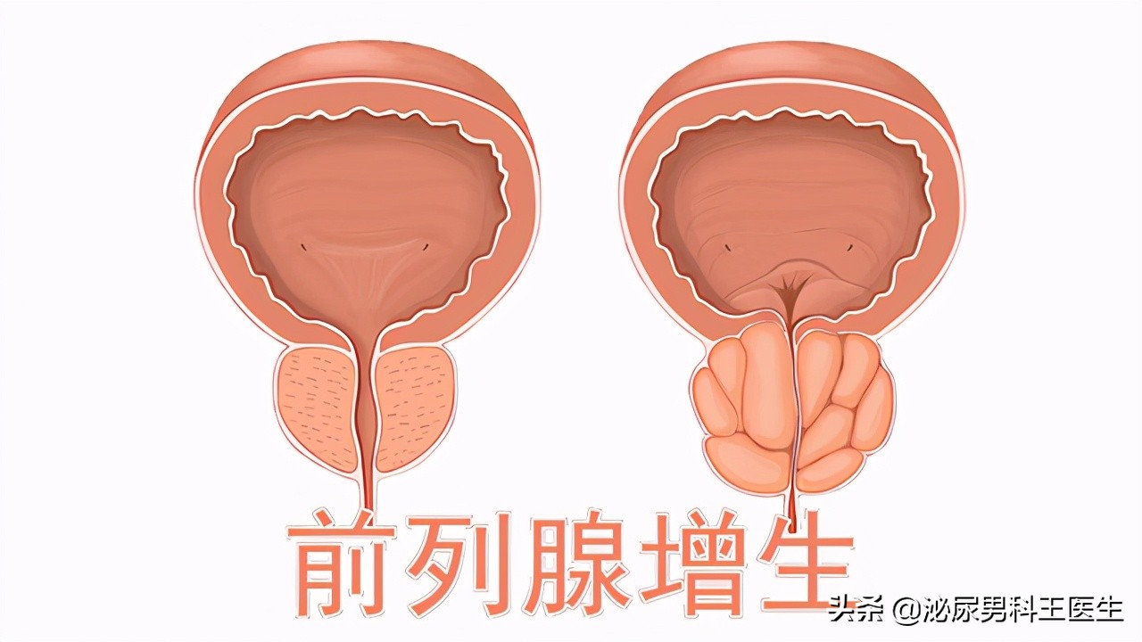 你了解过坦索罗辛吗？除了改善尿频，还能治疗3种常见的男科疾病