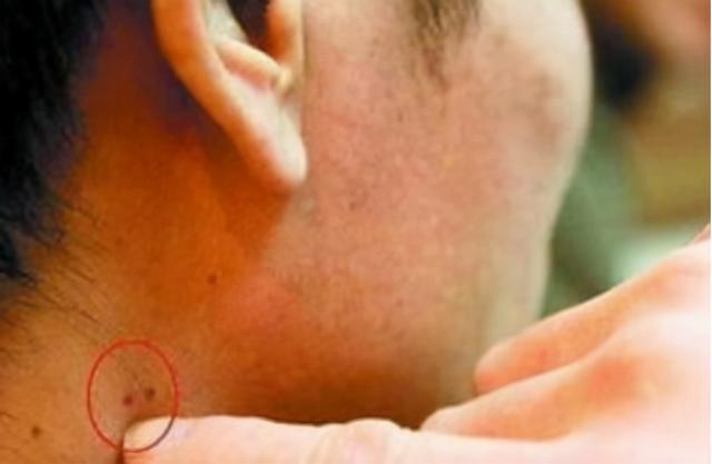 "艾滋病"在出现之前,皮肤会有哪些症状呢?建议了解,可别忽视