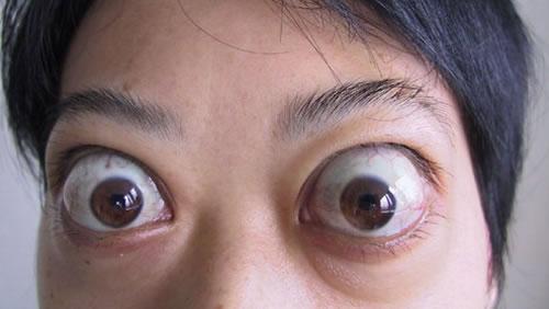 甲亢病患者所以我们可以大胆的假设,第一代蜀王蚕从眼睛会比较突出,有