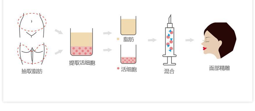 隆鼻手术必看，这些你务必要知道！