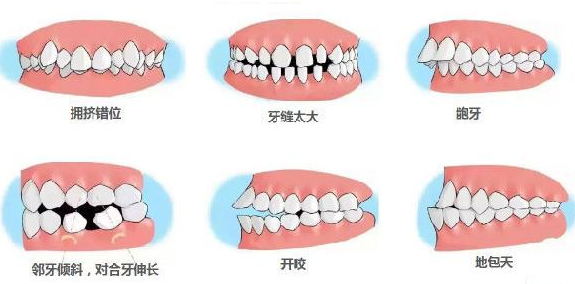 做牙齿矫正，你得先知道正畸可能出现的副作用，牙科医生的真建议