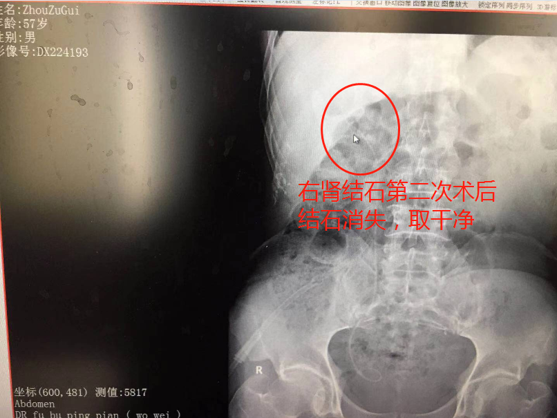 突发腰痛别小视！湖北大叔突感腰痛经查结石严重致肾功能受损