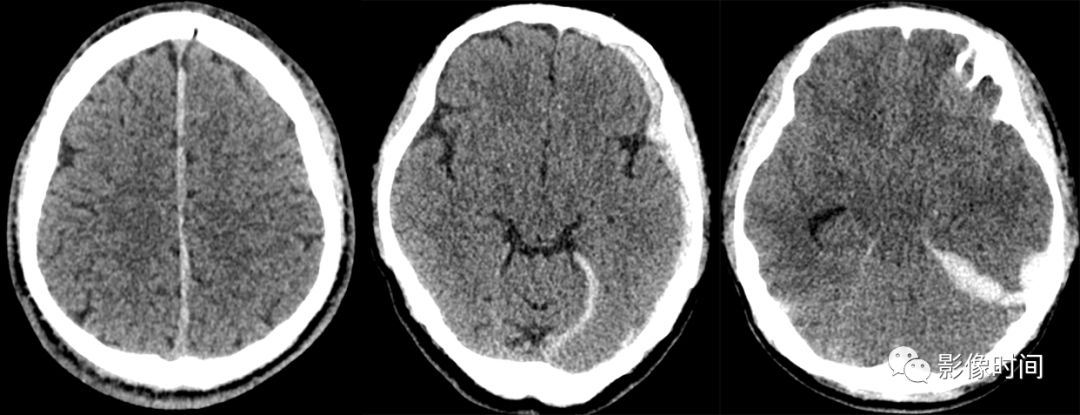 颅脑外伤的急诊 CT 表现