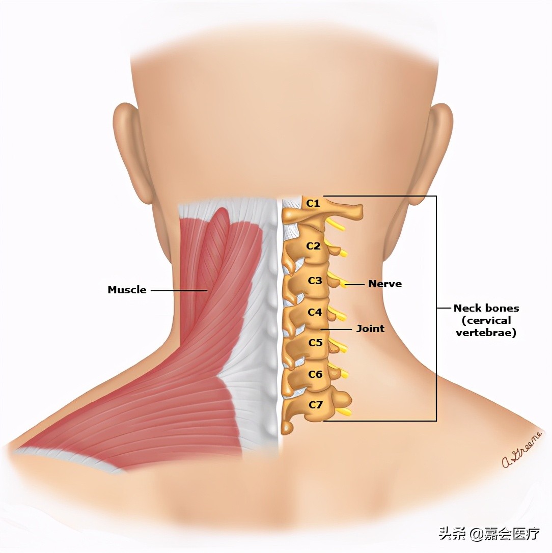 是由於頸椎間盤,頸椎鉤椎關節或關節突關節增生,肥大的骨贅向側方突出