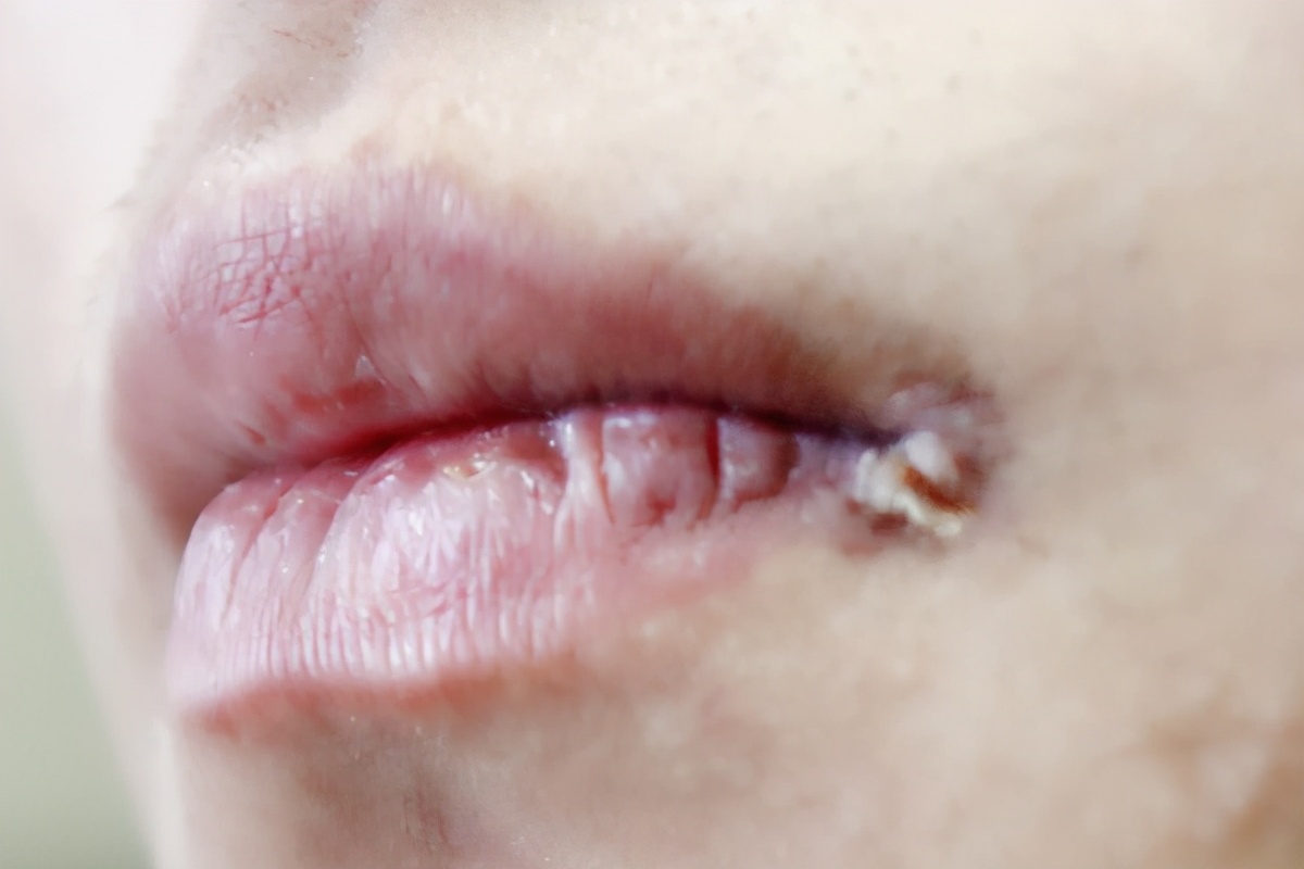 嘴角起泡是什么原因 嘴唇上火起泡图片-小螳螂百科网