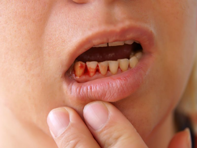 一歌手因牙龈癌去世,牙龈癌是什么病,它有什么症状?