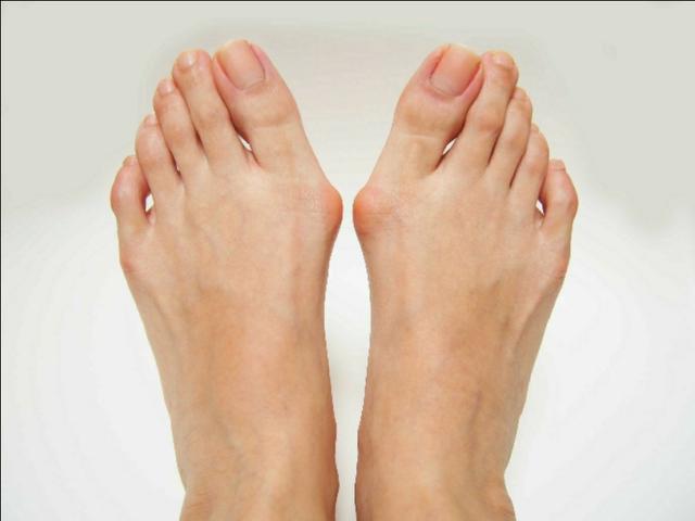 大脚拐,大脚趾内侧疼痛,要警惕:拇(趾)外翻,拇囊炎