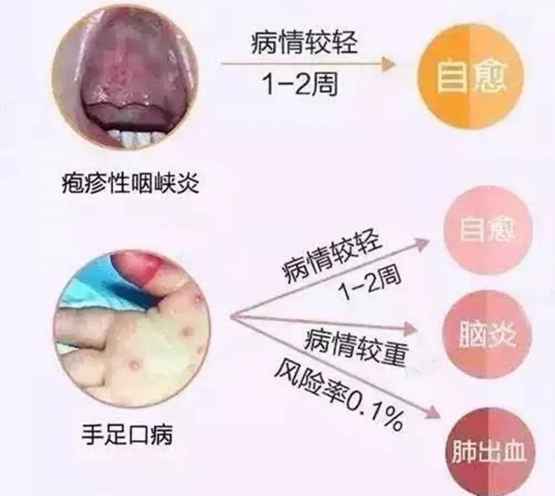 手足口的“表兄弟”近期来袭!病情痛苦,有娃的赶紧预防起来