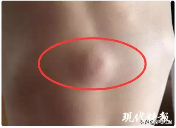 3岁男孩身上包块会“动”,从肚子右侧“跑”到左侧,医生划开一看…