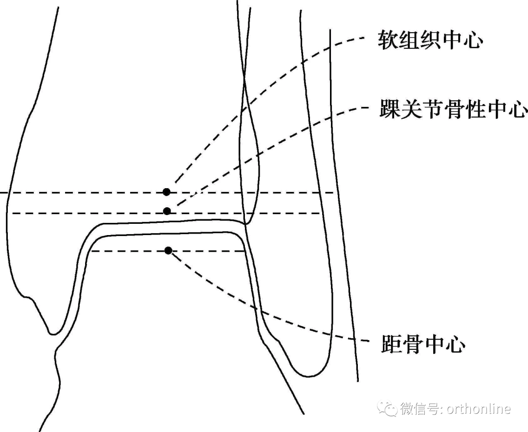 如何根据X线测量下肢力线