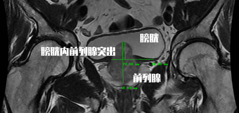 前列腺增生都有哪些危险因素？读者可以从哪些方面注意？