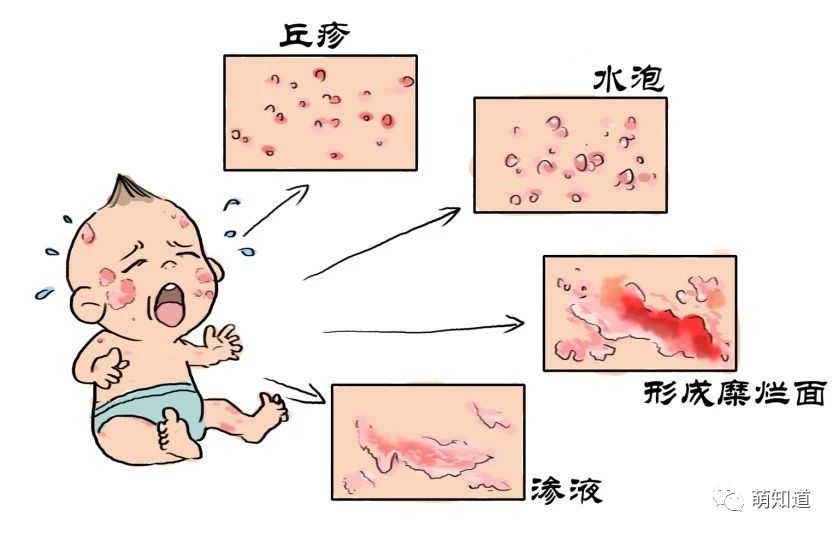 【常见病防治】婴幼儿湿疹：宝宝瘙痒难忍，妈妈我太难了！