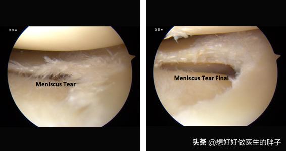 辟谣I微创手术治疗半月板，影响手术效果的这6点您有必要了解下