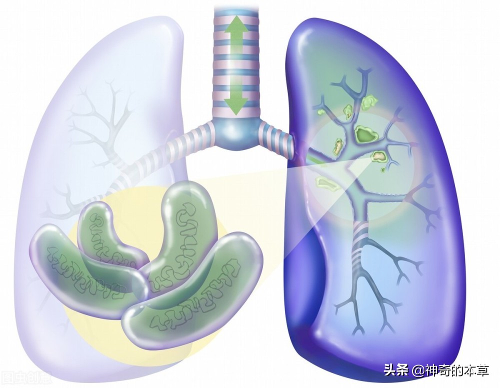 结核病足球的简单介绍(肺结核瘤是什么，跟肺结核有什么关系，怎么治疗)