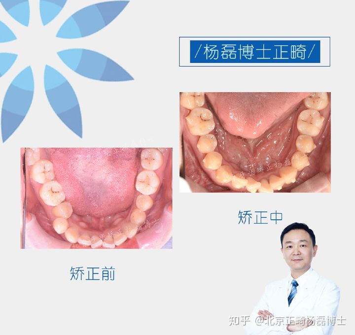 北京正畸杨磊博士：骨性反颌偏颌患者