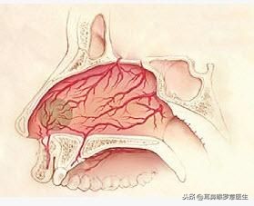 警惕！鼻涕带血，可能是这种癌症！