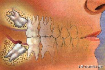 好好的智齿为什么拔了？并且价格比拔其它牙齿贵，听听医生解释！