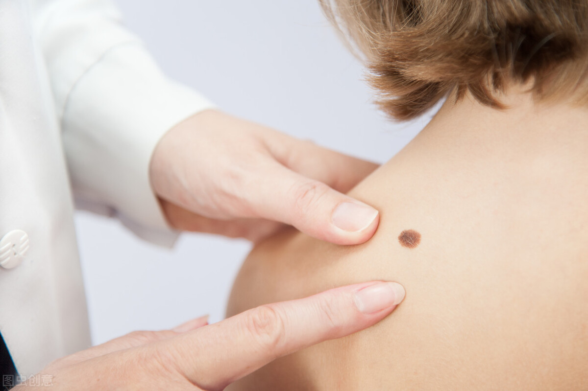 身体不容易见到的黑痣可能会癌变!长在3个地方要注意,及时处理