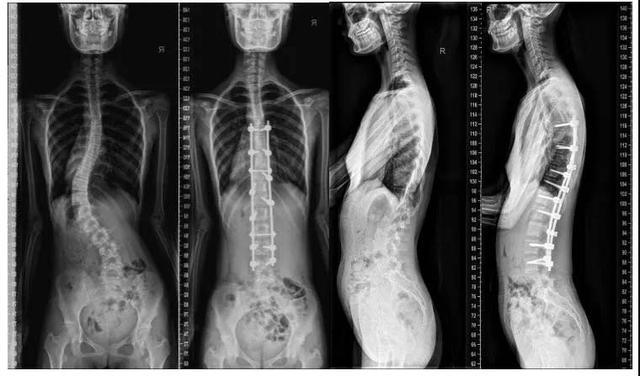 儿童驼背图片(孩子脊柱侧弯) - 赤虎壹号