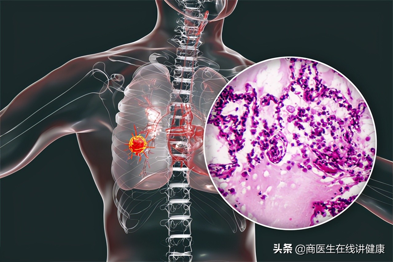 1万一次的PET-CT是什么？值得做吗？