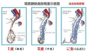 Doctor王建医学科普2:精索静脉曲张