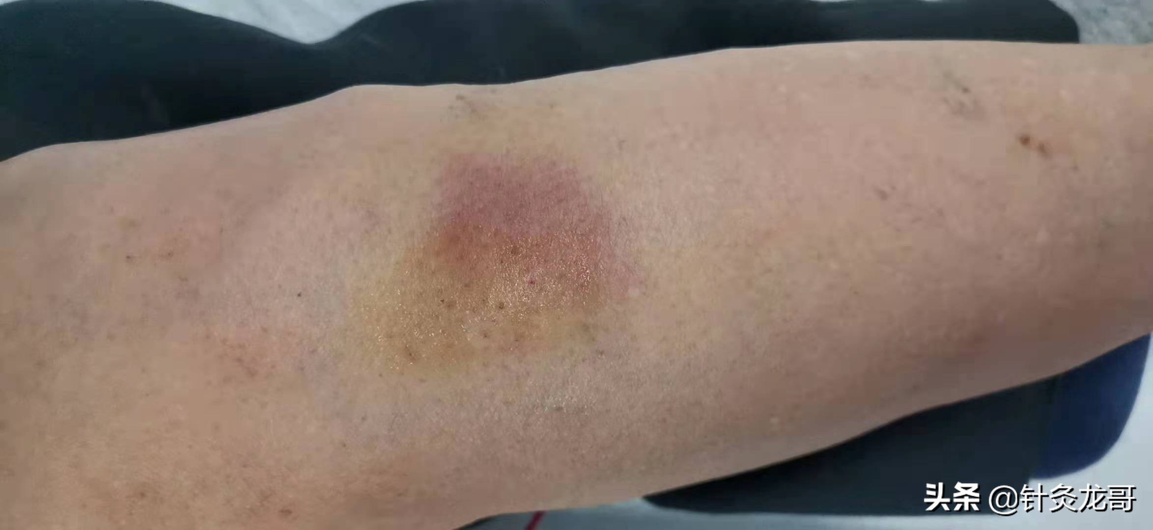 简单来讲,针灸针刺中了血管,血液淤积在局部,皮肤表面显现出淤血的