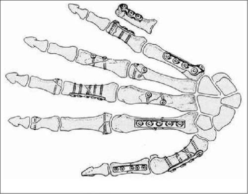 不生锈,很多患者表示怕钢板生锈骨科医生表示那是不可能的;和人体相容